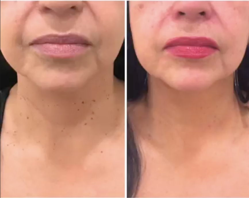 After treatment - Client 1